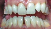 Izbjeljivanje zuba-poslije 3